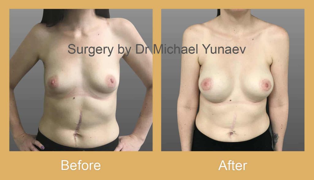 Cosmetic & Reconstructive Breast & Body Surgery Procedures in Tweed Heads